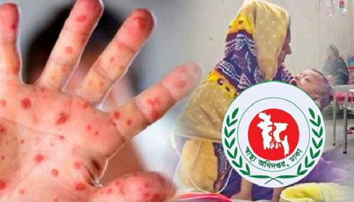 হামের উপসর্গ নিয়ে আরও ৫ শিশুর মৃত্যু